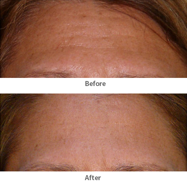 Forehead-Eight-Treatments-ba